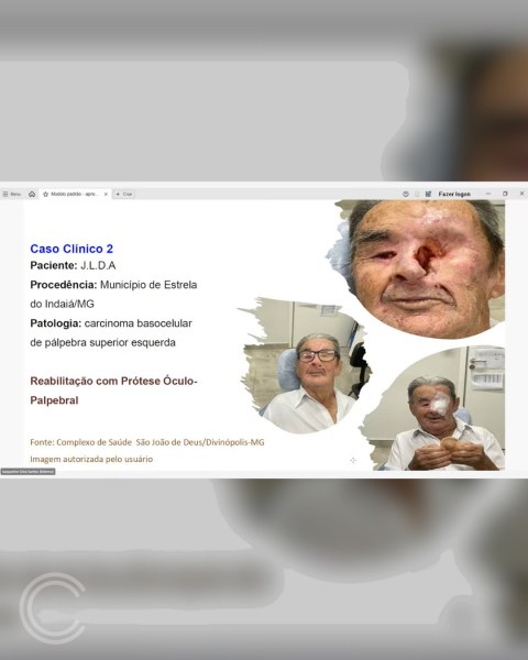 Imagem de um slide apresentando o Caso Clínico 2, que destaca a reabilitação de um paciente com carcinoma basocelular de pálpebra superior esquerda, mostrando detalhes sobre o tratamento com prótese óculo-palpebral, incluindo informações sobre o paciente e sua procedência.
