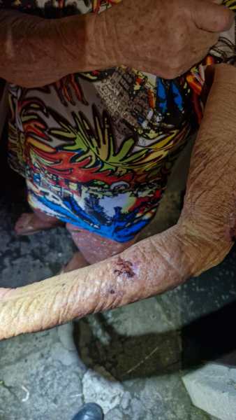 Close-up of a person's arm showing a wound on the forearm, with visible skin texture and colorful clothing in the background.