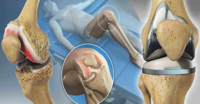 An anatomical illustration of a human knee joint, showing the bones, cartilage, and an inset image of the knee structure. The knee is depicted in relation to a surgical procedure, highlighting areas of potential injury or replacement.
